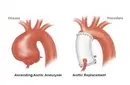 Asendan Aort Genişlemesi Belirtileri ve Tedavisi