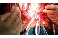 Aort Damarı Ameliyatı Riskleri ve Sonrası