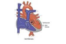 Aort Stenozu Nedenleri