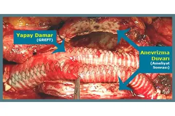 Aort Damarı Patlaması Belirtileri ve Tedavisi