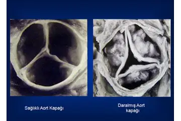 Aort Kapağı Kireçlenmesi Belirtileri ve Tedavisi