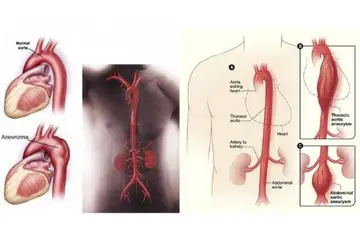 Torasik Aort Anevrizması Belirtileri ve Tedavisi