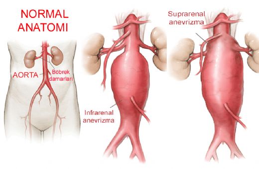 Abdominal Aort Anevrizması Belirtileri ve Tedavisi