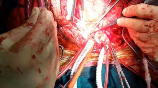 Abdominal Aort Anevrizması Ameliyatı Riskleri ve Sonrası