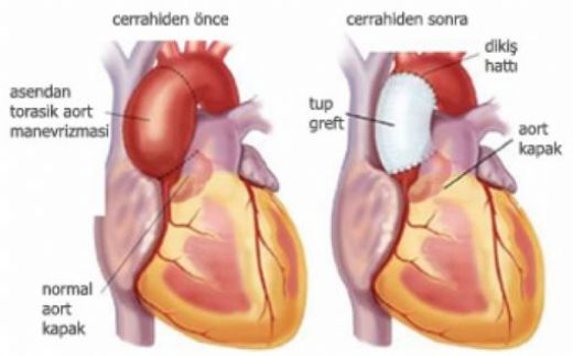 Aort Anevrizması Belirtileri ve Tedavisi