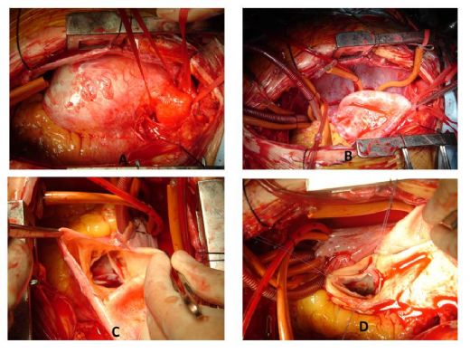 Aort Anevrizması Ameliyatı Riskleri ve Sonrası