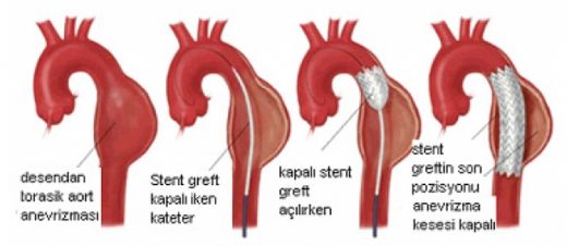 Aort Dalları Nelerdir?