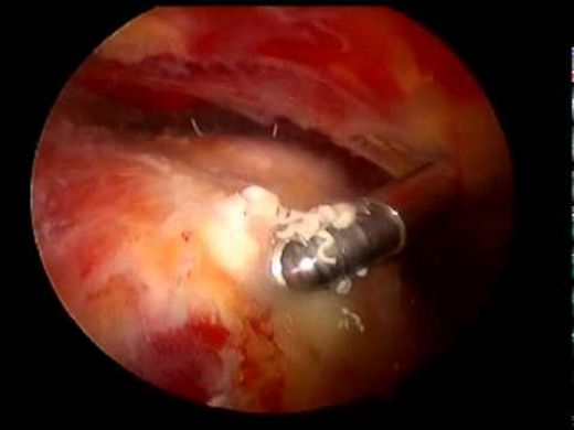 Aort Damarı Daralması Belirtileri ve Tedavisi