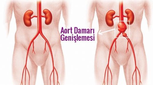 Aort Damarı Genişlemesi Belirtileri ve Tedavisi