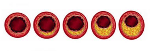 Aort Damarı Kireçlenmesi Belirtileri ve Tedavisi
