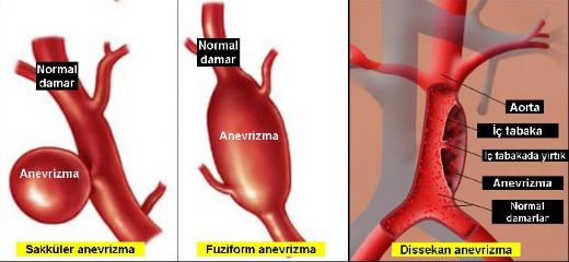 Aort Damarı Şişmesi Belirtileri ve Tedavisi
