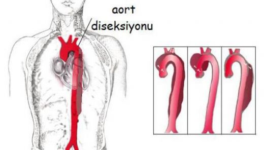 Aort Diseksiyonu Belirtileri ve Tedavisi