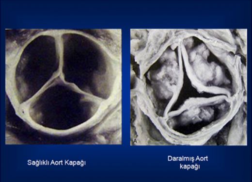 Aort Kapağı Kireçlenmesi Belirtileri ve Tedavisi