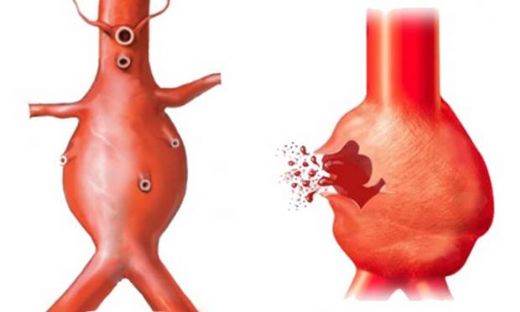 Aort Nedir Aort Genişlemesi Tehlikeli Midir?