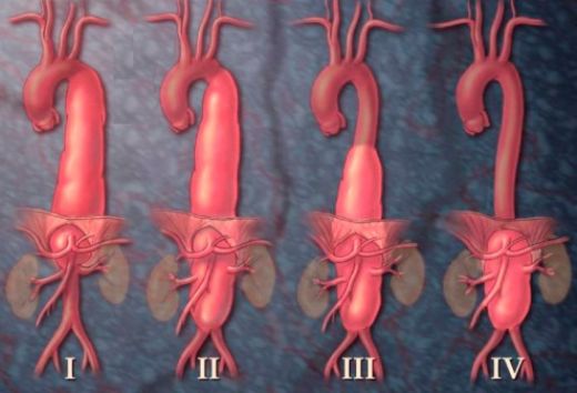 Aort Rüptürü Belirtileri ve Tedavisi