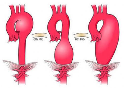 Aort Topuzu Belirtileri ve Tedavisi