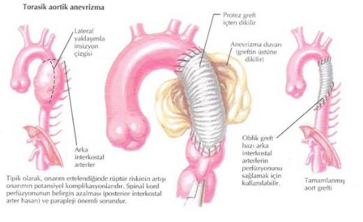Arkus Aorta Bölümleri