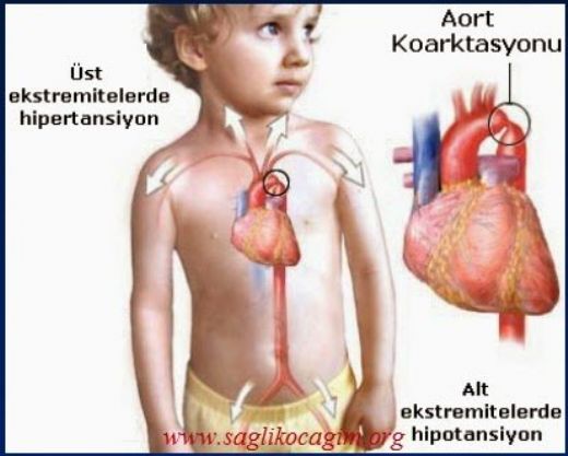 Doğuştan Aort Darlığı Belirtileri ve Tedavisi