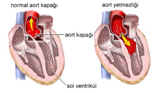Hafif Aort Yetmezliği Belirtileri ve Tedavisi