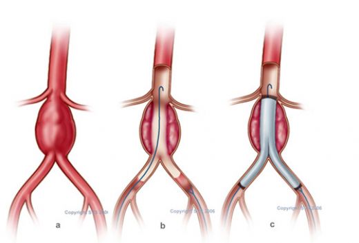 Yapay Aort Damarı Ameliyatı